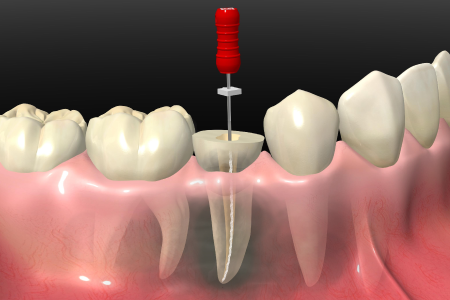 歯根のう胞の摘出